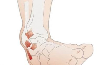 Ankle Sprains