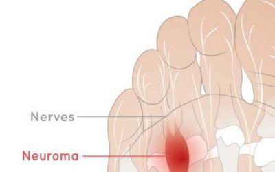 Morton’s Neuromas