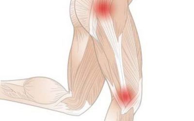 Illiotibial Band Syndrome