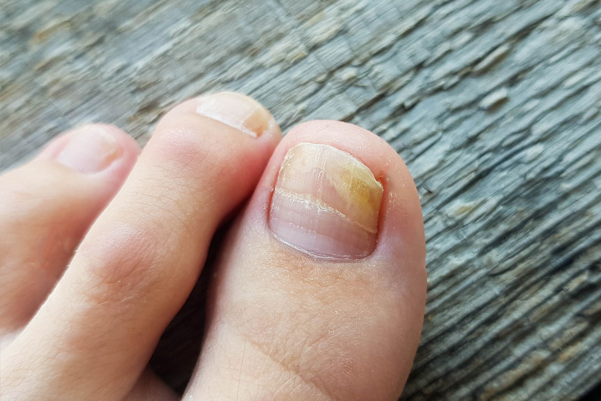 Onychomycosis and Fungal Nail Infections
