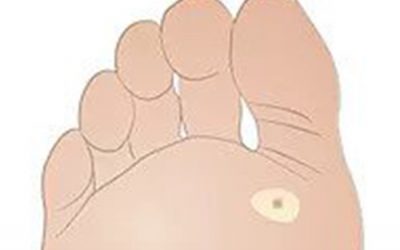 Verrucas Plantar Warts